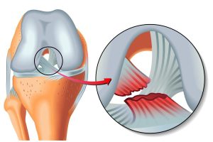 poškodba križne vezi